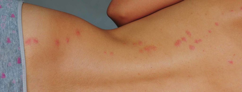 Bed Bug Pest Control From Pest2Kill